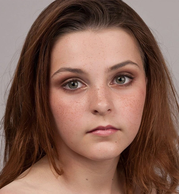 女性面部雀斑和色斑密布